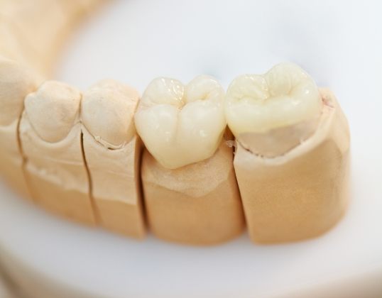 Model smile with all ceramic dental restorations