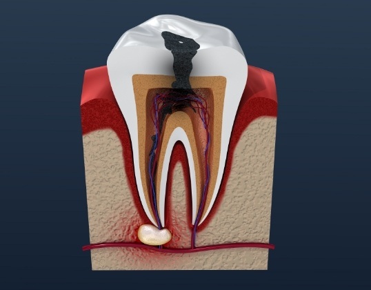 Animated tooth with decay and pulp infection