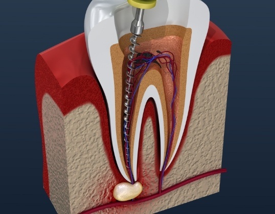 Animated tooth during pulp therapy treatment