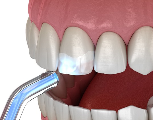 Digital image of cosmetic bonding