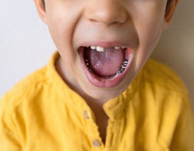 Child with stainless steel crowns