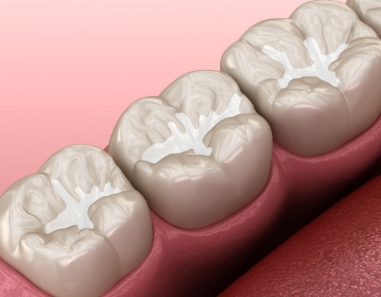 Closeup of animated teeth with dental sealants