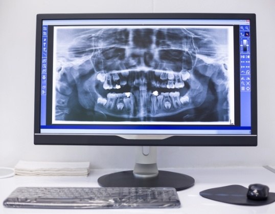 Digital x rays on chairside computer