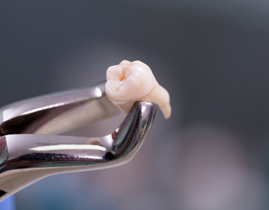 Factors that can affect the cost of a tooth extraction include the location of the tooth