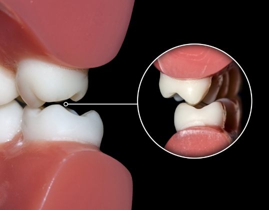 Closeup of smile with bruxism