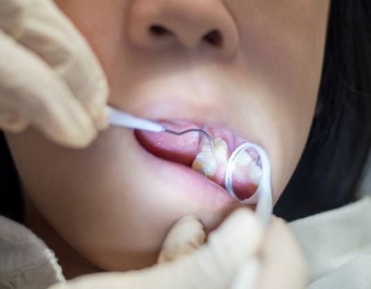 Pediatric dentist performing the filling treatment process