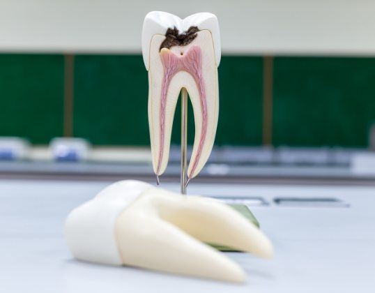 Model of tooth showing damaged pulp layer