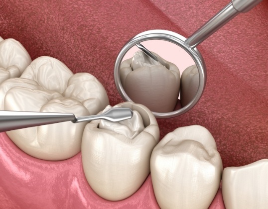 Animated smile during pediatric dental filling placement