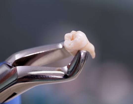 Metal clasp holding a tooth after extraction