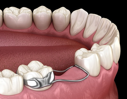 Digital image of a space maintainer